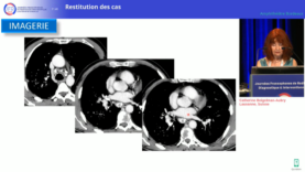 Cas clinique d’imagerie thoracique – Octobre 2023