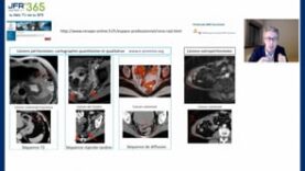 IRM versus TDM pour la carcinose péritonéale