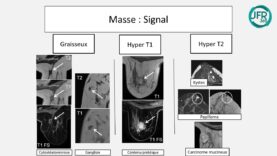 Préparons les JFR – SIFEM – Interprétation en IRM mammaire